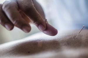 Benefits of Integrating Acupuncture & Chiropractic Care Casselberry, FL