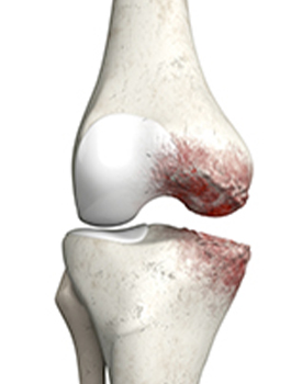 Common Joint Injuries and Conditions Altamonte Springs, FL