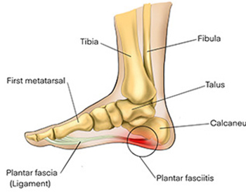 Non-Surgical Treatments for Plantar Fasciitis Longwood, FL