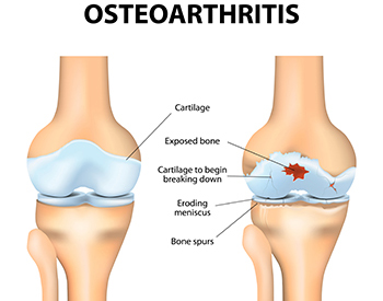 Osteoarthritis Treatment Options Longwood, FL