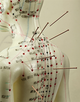 What is Acupuncture? Altamonte Springs, FL